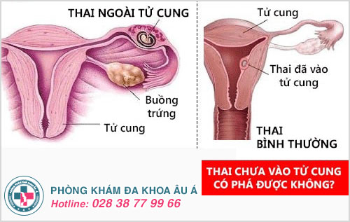 Thai chưa vào tử cung có phá được không? giải đáp chi tiết từ bác sĩ chuyên khoa